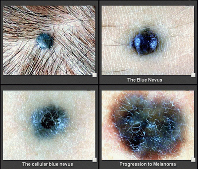 Причины появления, виды и методы лечения голубого невуса на коже