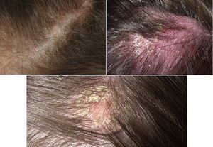 Причины, симптомы и лечение дерматита на коже головы