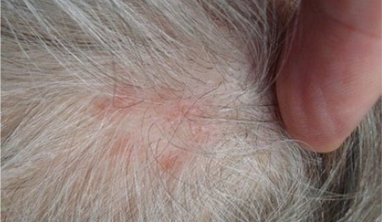 Причины и лечение опоясывающего герпеса на голове в волосах