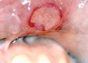 Причины возникновения и лечение сыпи в ротовой полости и на щеках