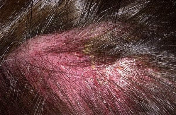 Как лечить себорейный дерматит на волосистой части головы