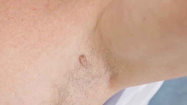 Как выглядит бородавка под кожей и другие разновидности папиллом