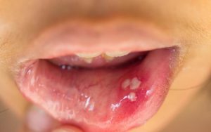 Папилломы во рту: причины появления ВПЧ и как лечить папилломатоз