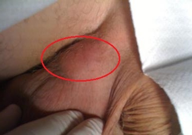 Причины образования шишки под кожей на мошонке у мужчин