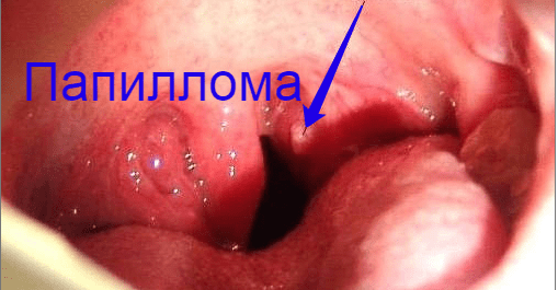 Признаки наличия и лечение папилломатоза гортани