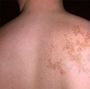 Причины появления темных пигментных пятен на спине