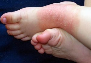 Экзема на ногах: причины, симптомы, лечение в домашних условиях