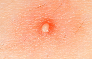 Внутренний фурункул: причины образования чирьев под кожей и лечение