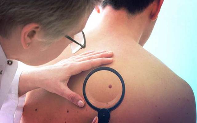 Методы лечения меланомы: как лечат опухоль кожи