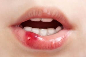 Причины возникновения мозолей и волдырей на губе у новорожденного