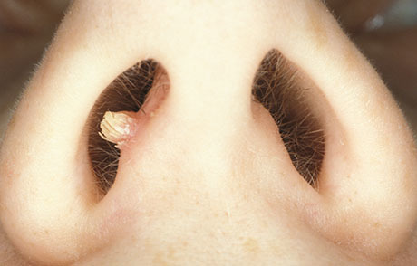 Причины возникновения папилломы в носу и её лечение и удаление