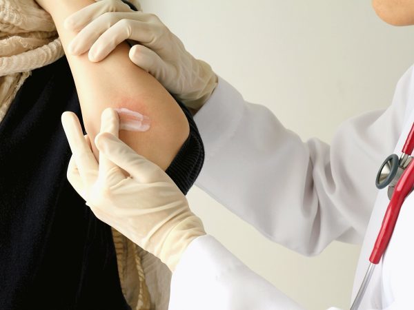 Причины возникновения и лечение сухой экземы на руках