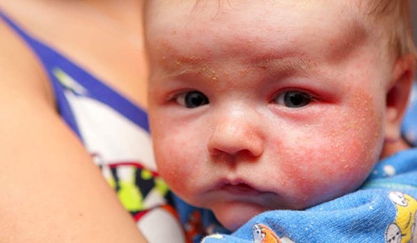 Симптомы, виды, лечение аллергического и линейного дерматита у ребенка