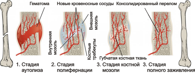 Механизм образования костной мозоли после переломов