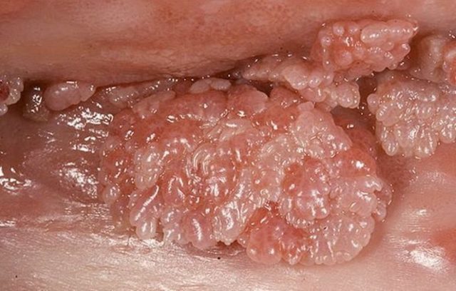 Папилломатоз вульвы: причины и удаление папиллом во влагалище