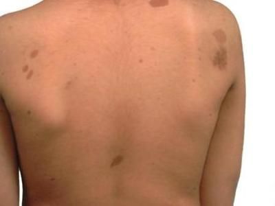 Пигментные пятна на спине: причины появления и способы удаления