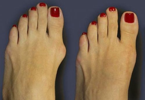 Нарост на пальце ноги: причины появления и особенности лечения