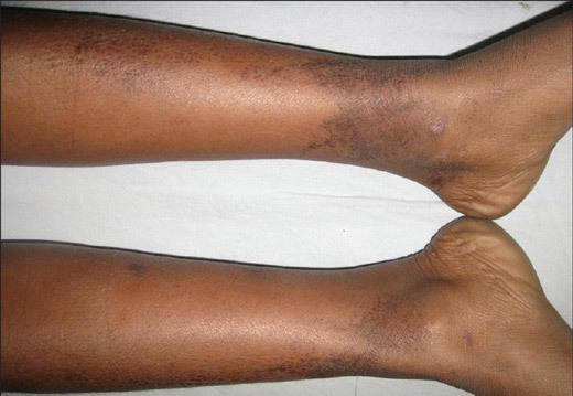 Причины появления и способы лечения коричневых пятен на коже ног