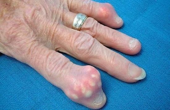 Твердый нарост на пальце руки: причины, симптомы, лечение