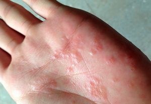 Причины и лечение экземы на ладонях и пальцах рук