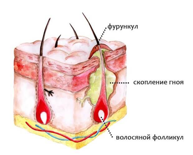 Причины появления фурункулов на теле, способы лечения нарывов