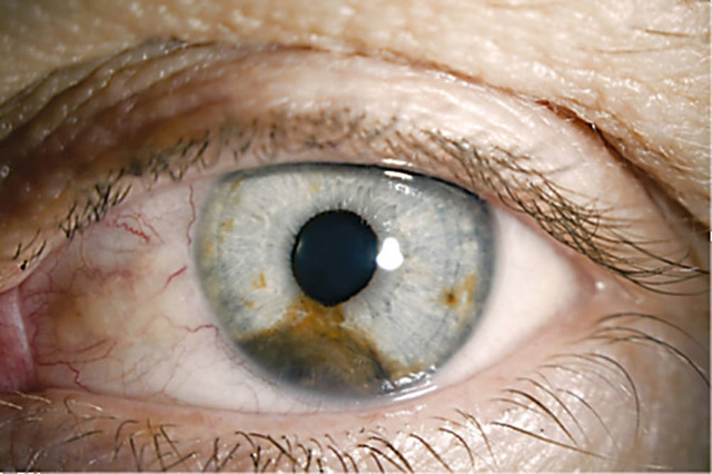 Нарост на глазу: причины и лечение образования на глазном яблоке