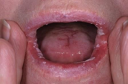Основные симптомы и лечение грибка в полости рта и горла