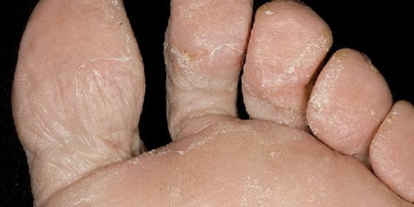 Чем лечить грибок на ногах между пальцами в домашних условиях