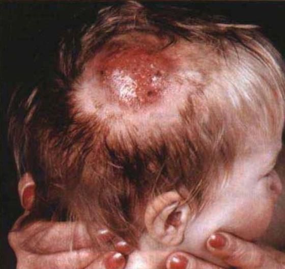 Грибок кожи головы: причины, симптомы и лечение