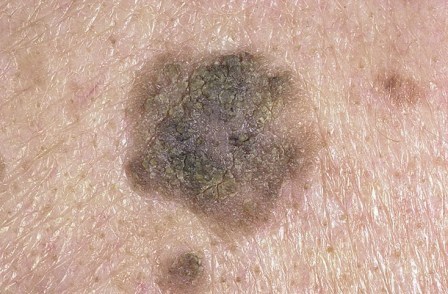 Причины возникновения кератом на коже и их лечение