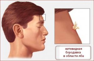 Папилломы на лице: причины появления и методы лечения патологии