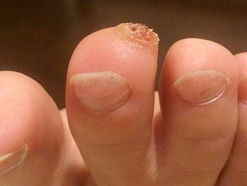 Шипица на пальце ноги: причины, симптомы и лечение