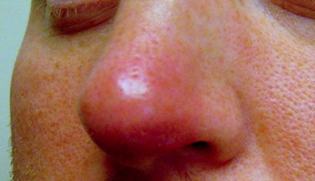 Фурункул на носу: причины, симптомы и особенности лечения