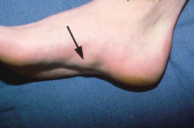 Безболезненное удаление фибромы под кожей на ноге