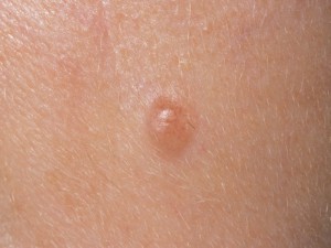 Папилломатозный внутридермальный меланоцитарный невус кожи