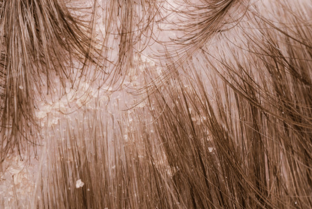 Методы лечения себореи кожи головы в домашних условиях