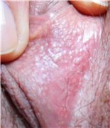 Симптомы и лечение микропапилломатоза половых губ у женщин