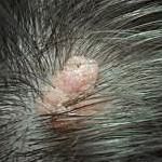 Причины образования и удаление папилломы в волосистой части головы