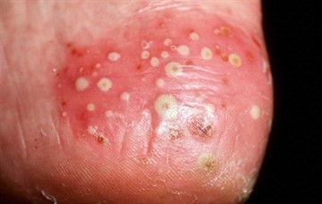 Симптомы дерматозов: как выглядит псориаз в начальной стадии