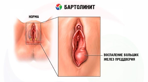 Фурункул на половой губе: причины, симптомы и лечение гнойника
