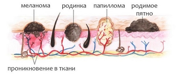 Как выглядит бородавка под кожей и другие разновидности папиллом