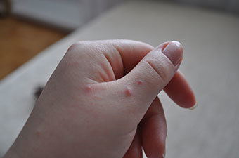Почему на руках могут появиться мелкие пупырышки, которые чешутся