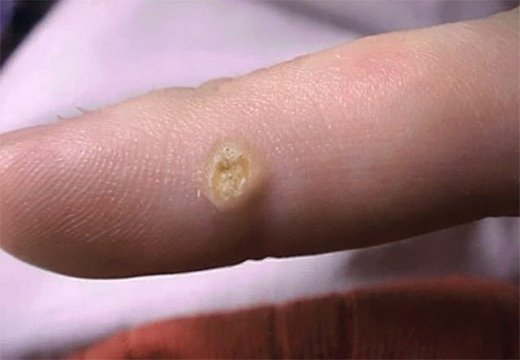 Причины и методы удаления шипицы на пальце руки