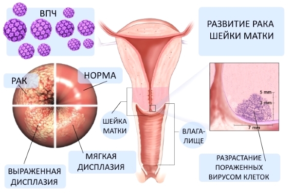 Папилломавирусная инфекция у женщин: причины, симптомы и лечение