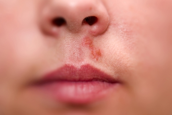 Причины появления и лечение прыщей под носом у женщин и мужчин