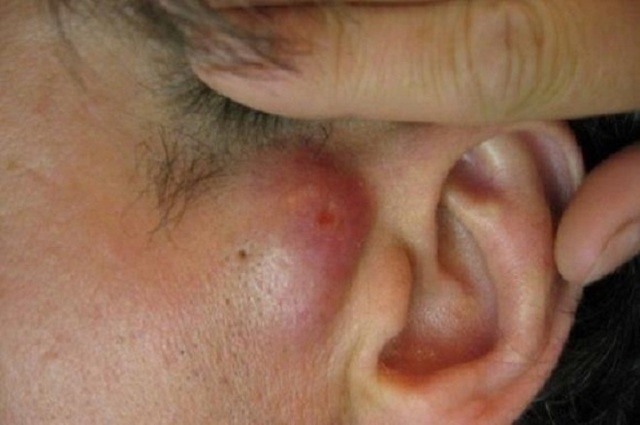 Причины воспаления сальных желез и лечение атеромы за ухом