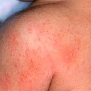 Симптомы, виды, лечение аллергического и линейного дерматита у ребенка