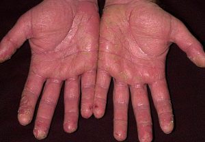 Причины и лечение экземы на ладонях и пальцах рук