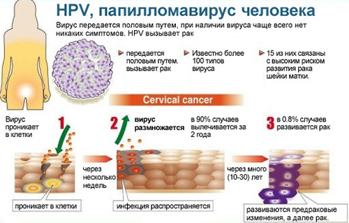 Лечение вируса папилломы человека (ВПЧ)