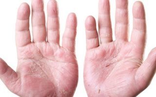 Лечение дерматита на руках мазями и кремами